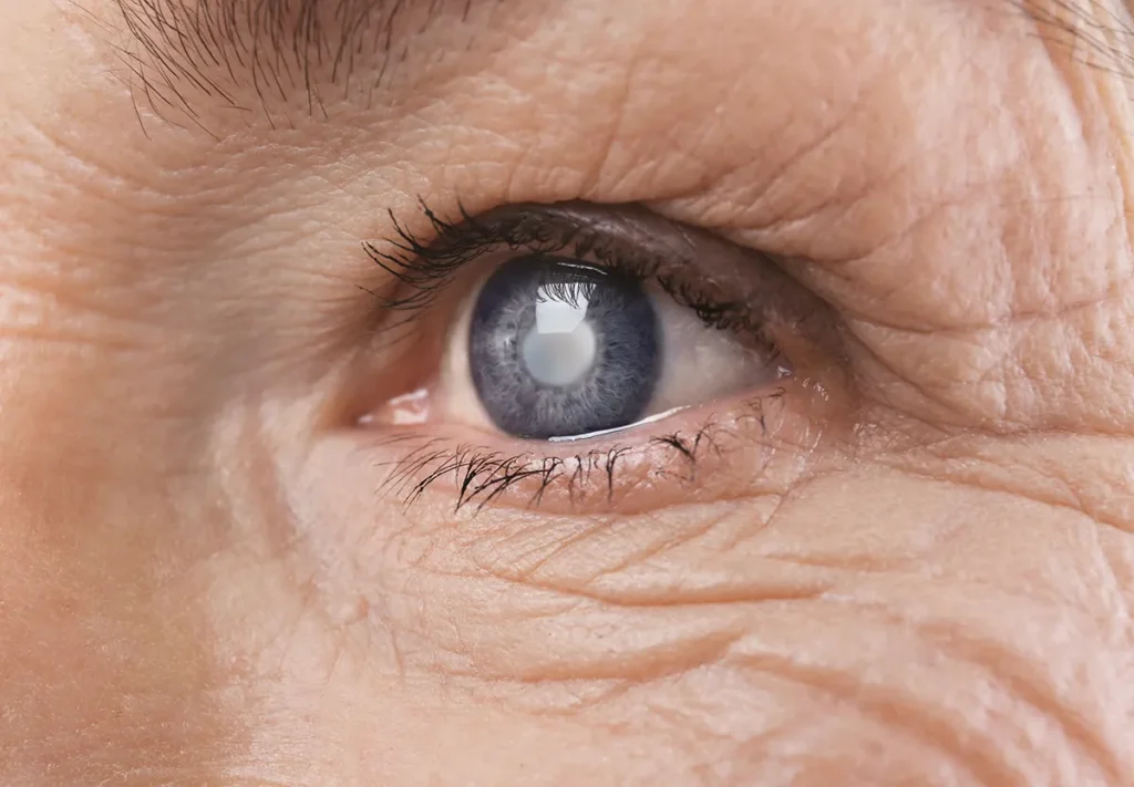 close-up of a woman's eye with a cataract