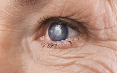 Early Signs of Cataracts: What to Watch For